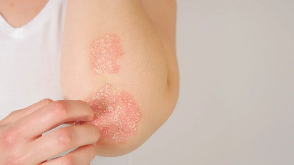 Red Light Therapy for Psoriasis: What the Research Shows