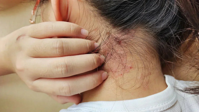 Red Light Therapy for Eczema: Relief for Itching, Redness, and Flare Recovery