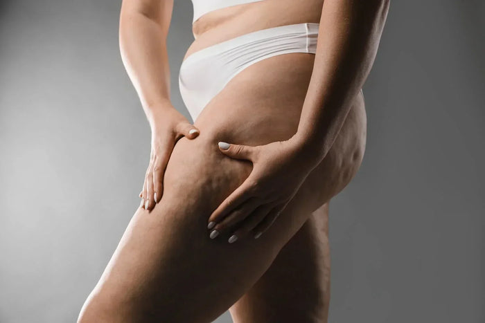 woman with cellulite on leg