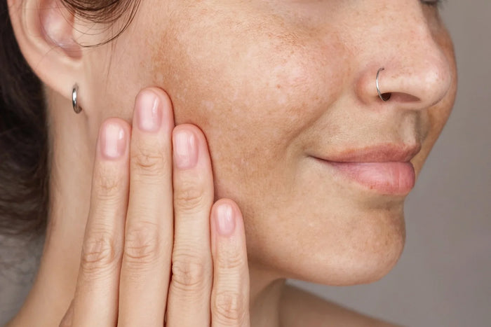 Red Light Therapy for Melasma: How It May Help Dark Spots and Pigmentation