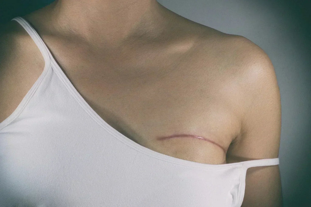 Red Light Therapy for Scars: Improving Texture, Tone, and Recovery