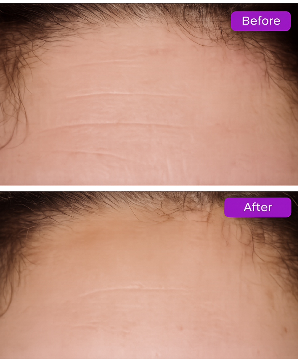 Reduce Wrinkles