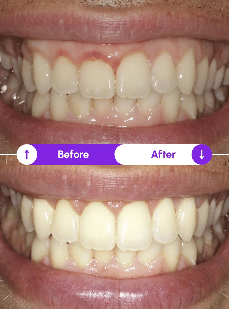 James R. — gums before and after using Novaa Oral Care Pro red light therapy: bleeding gums stopped
