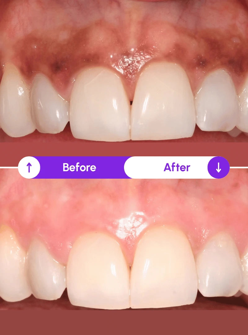 Emily S. — gums before and after using Novaa Oral Care Pro red light therapy: inflammation healed