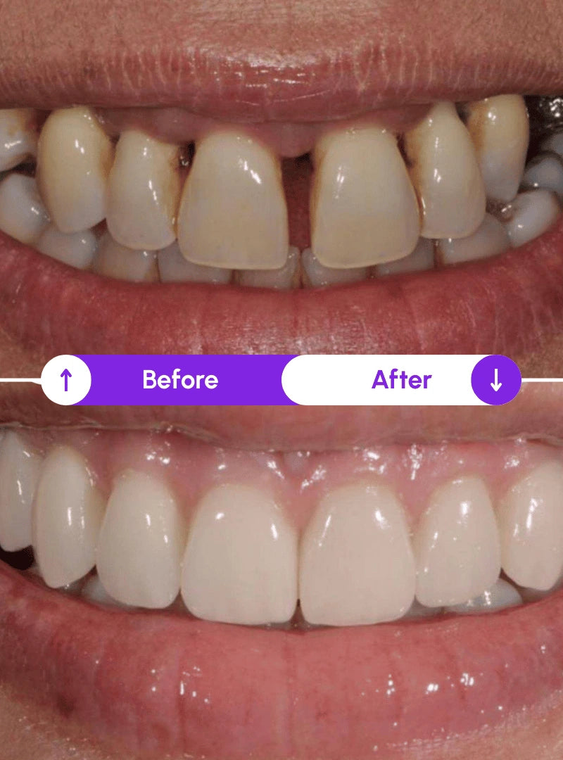 Gums and teeth before and after using the Novaa Oral Care Pro red light therapy for gum disease