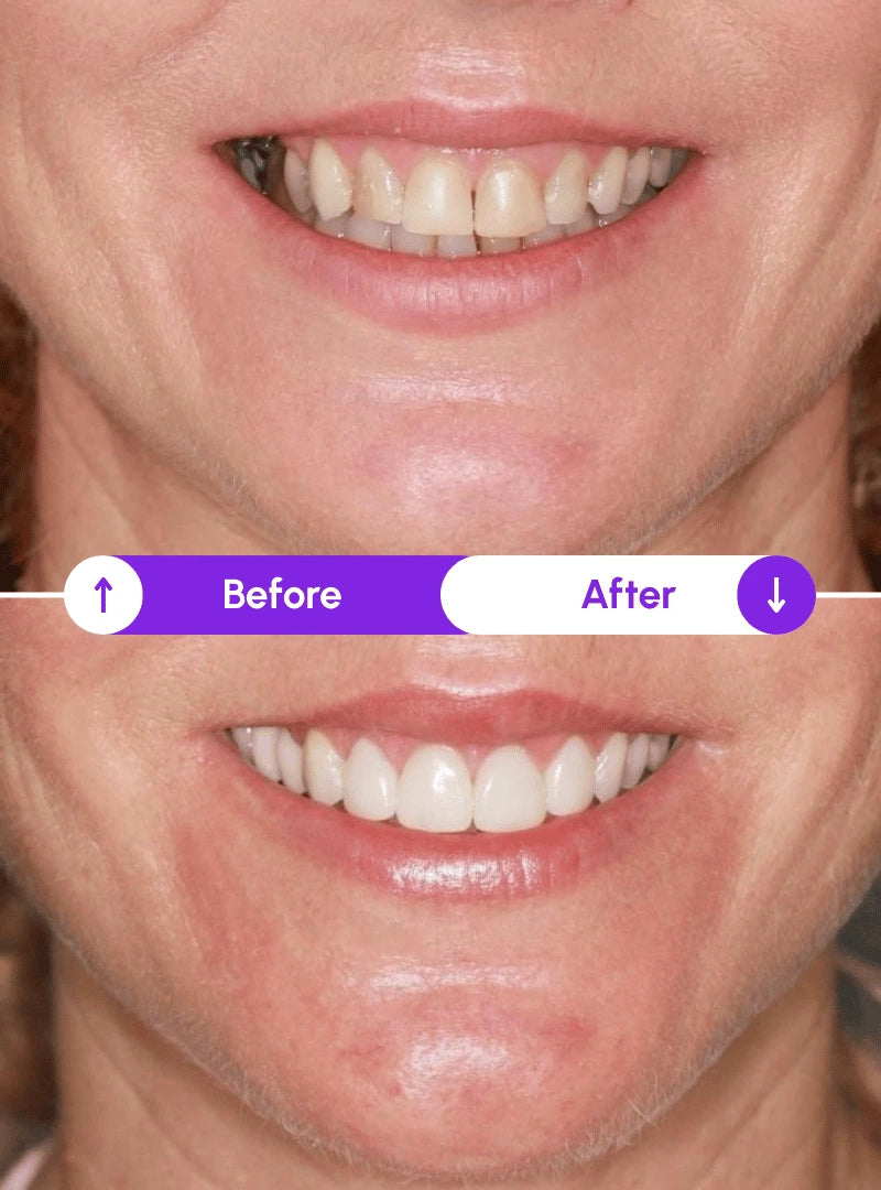 Meghan S. — gums before and after using Novaa Oral Care Pro red light therapy: receding gums restored